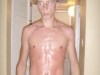 Sunburn